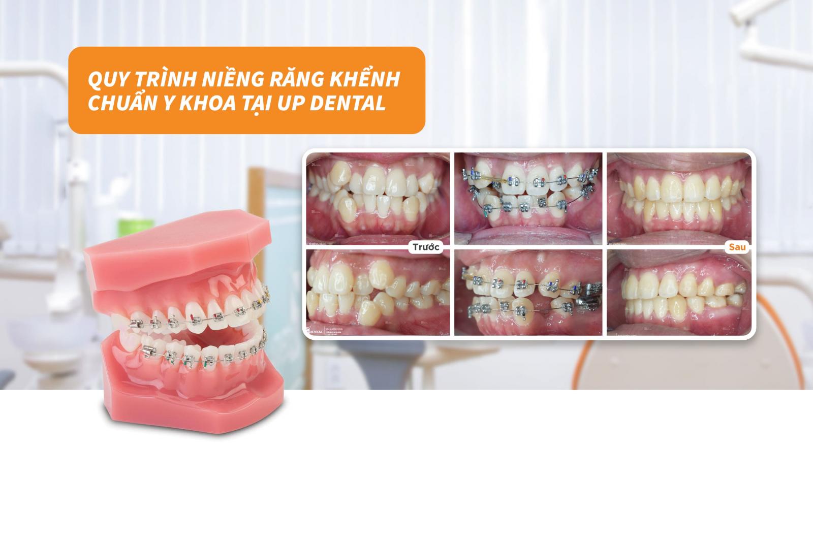 Quy trình niềng răng khểnh chuẩn Y khoa tại Up Dental