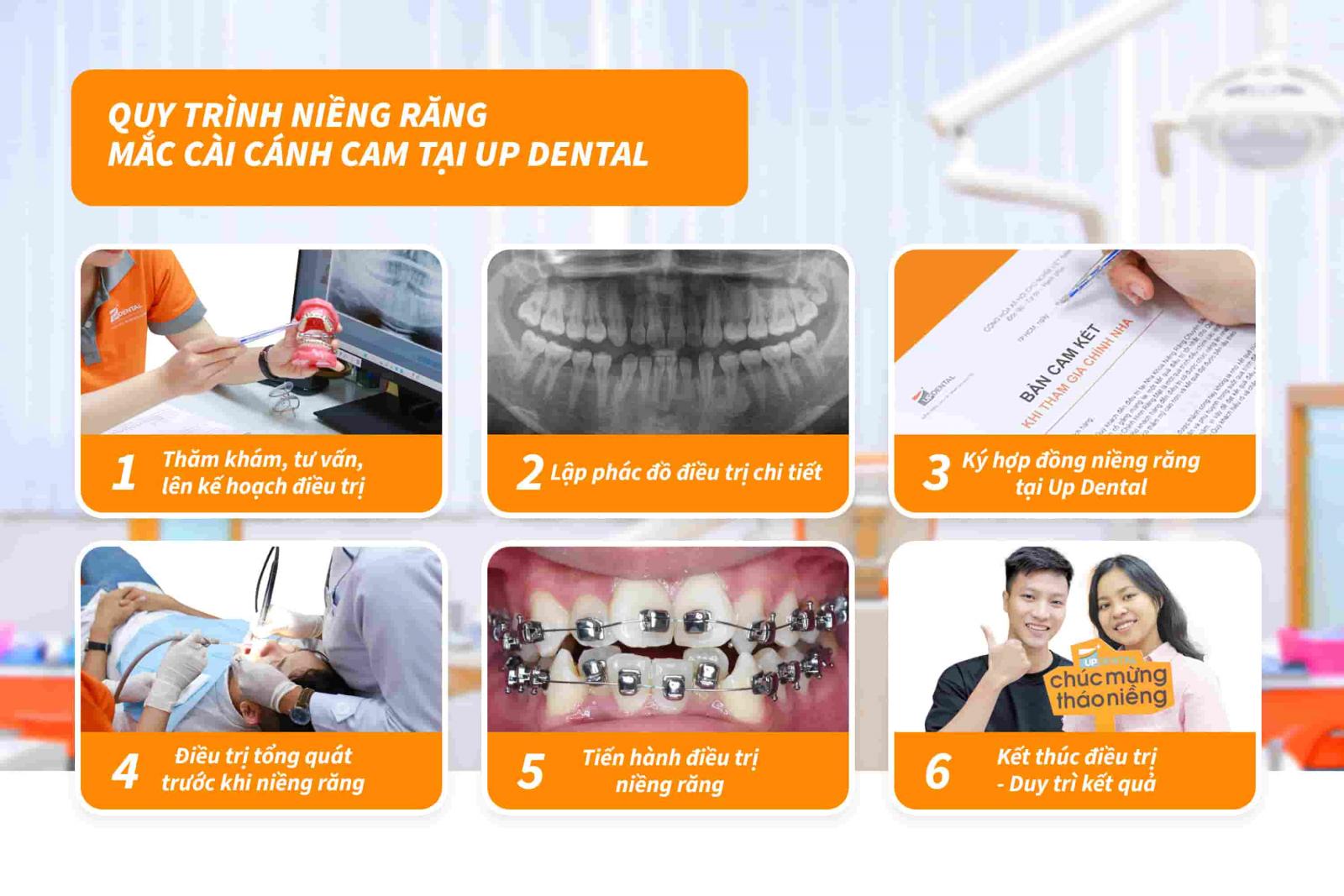 Quy trình niềng răng mắc cài cánh cam tại Up Dental