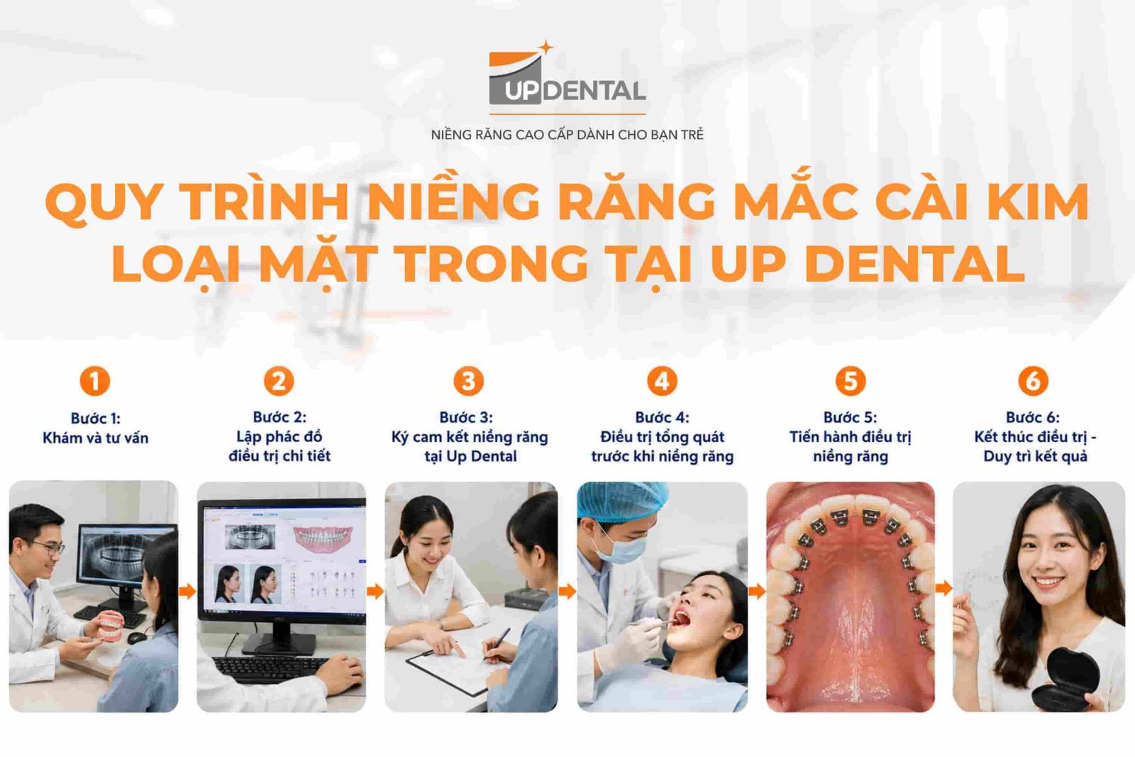 Quy trình niềng răng mắc cài kim loại mặt trong tại Up Dental