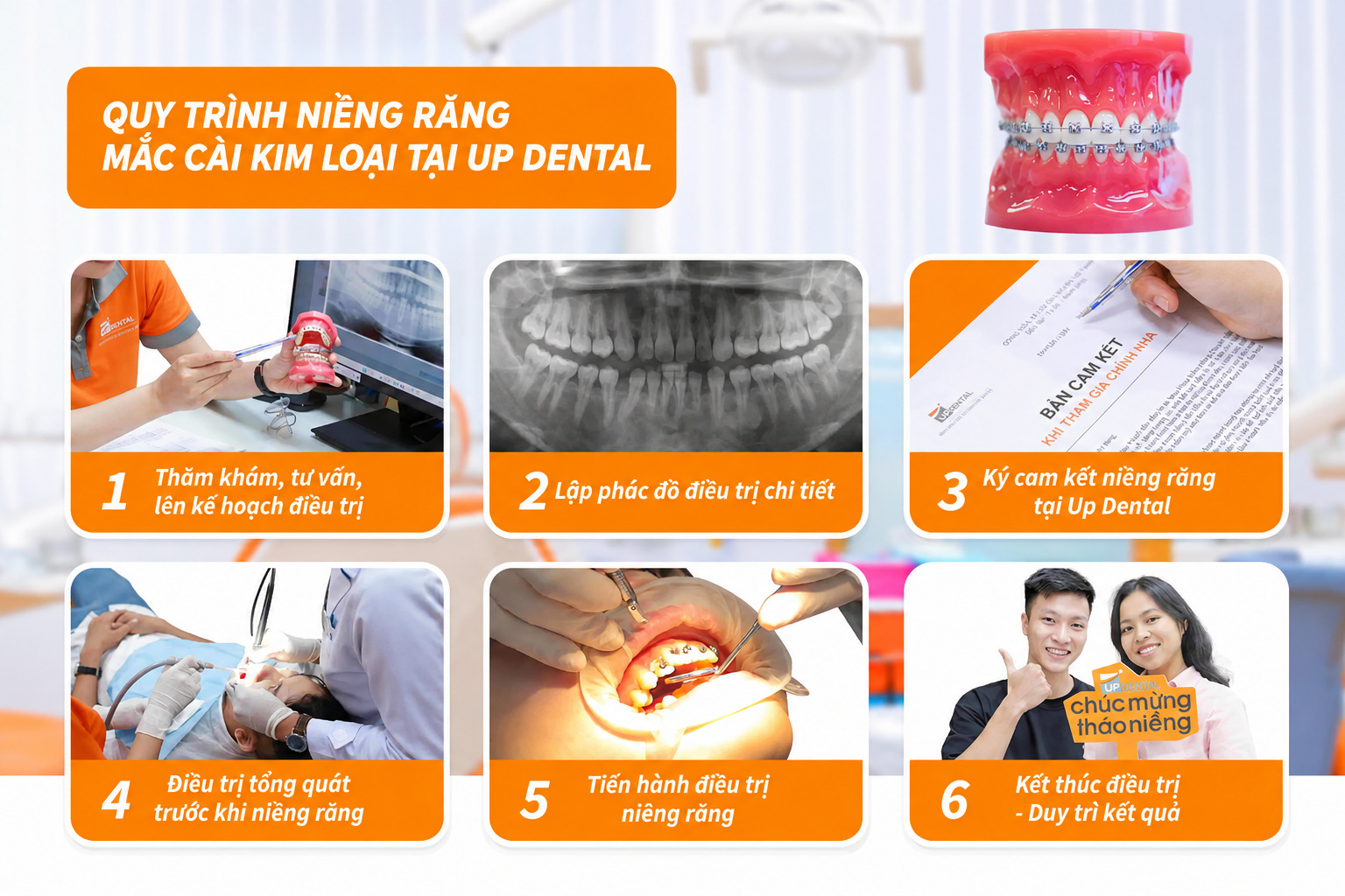 Quy trình niềng răng mắc cài kim loại
