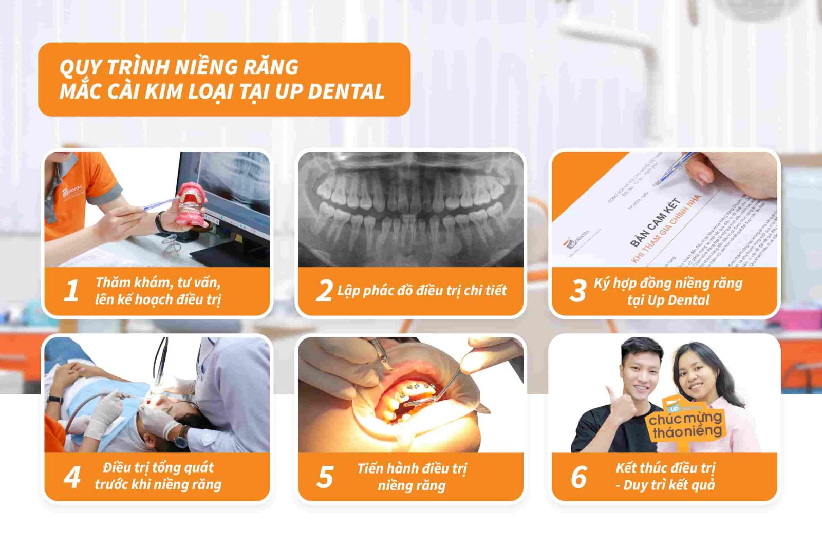 Quy trình niềng răng mắc cài kim loại tại Up Dental 