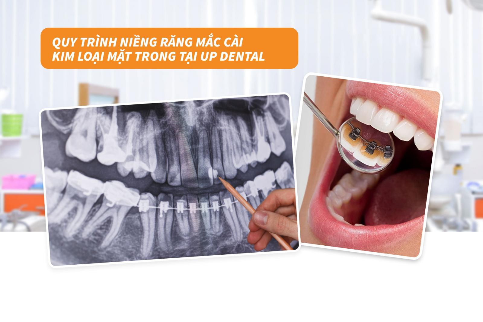 Quy trình niềng răng mắc cài kim loại mặt trong tại Up Dental