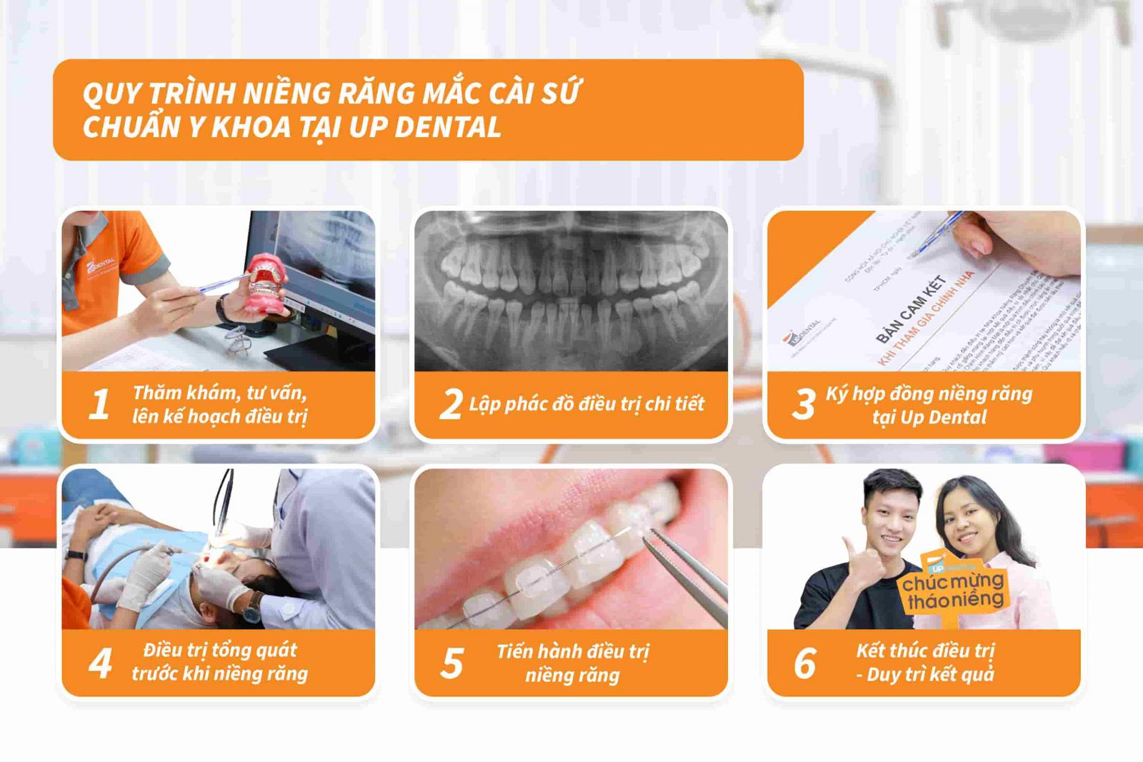 Quy trình niềng răng mắc cài sứ chuẩn Y khoa tại Up Dental
