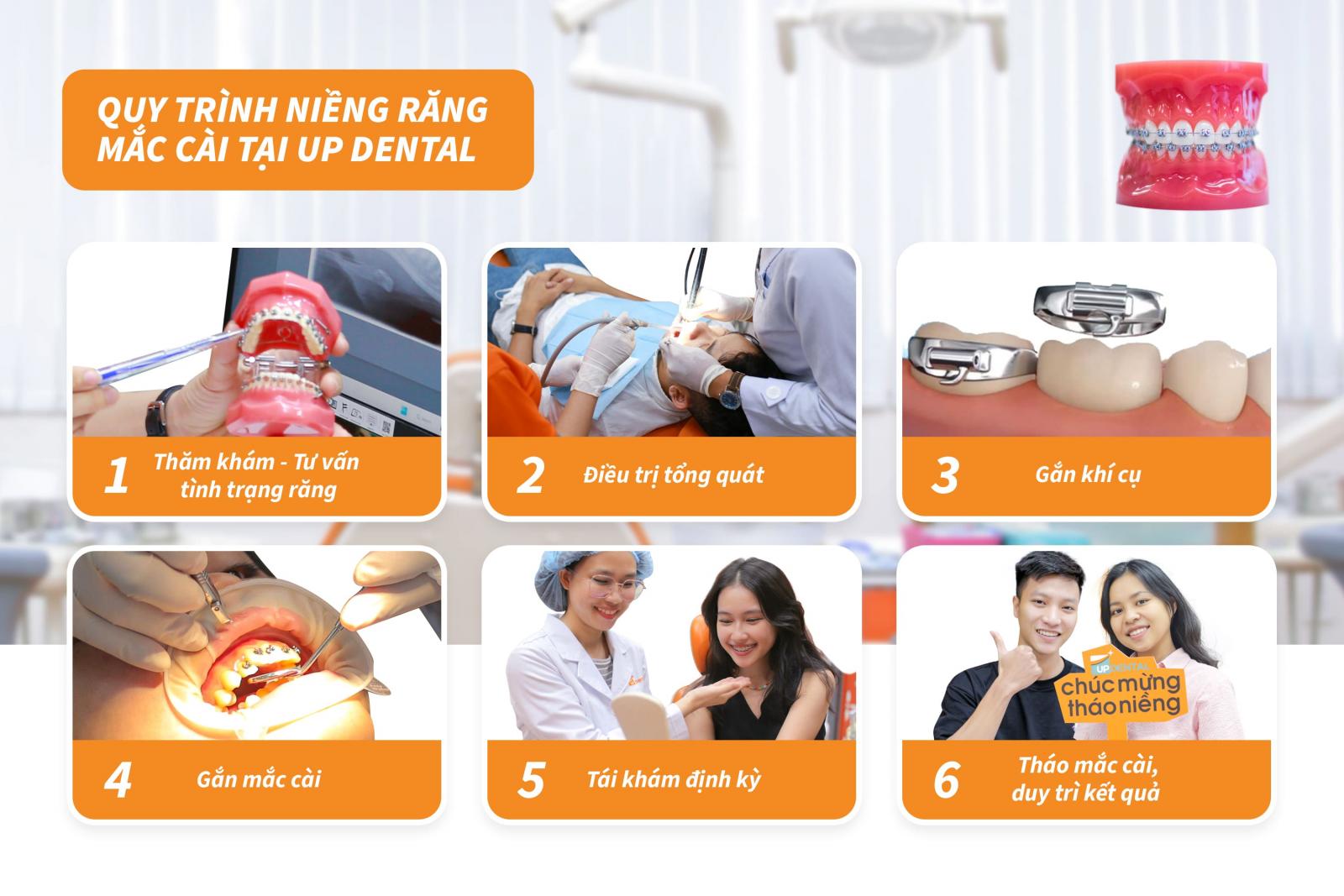 quy trình niềng răng mắc cài tại up dental