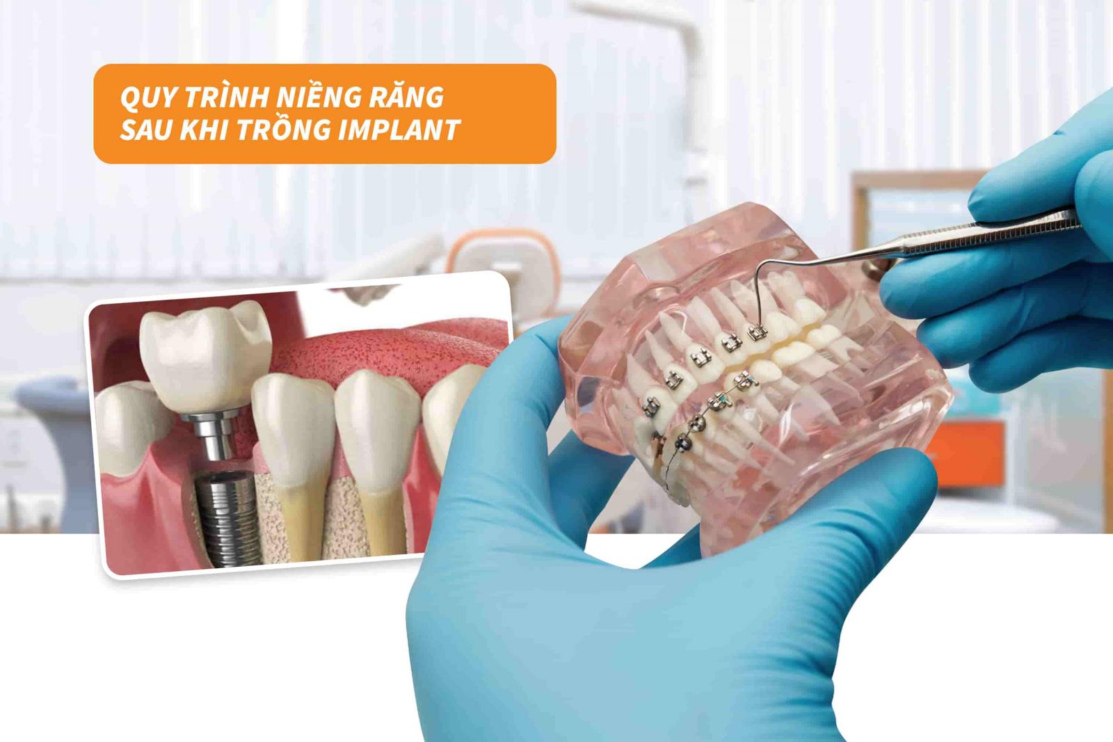 Quy trình niềng răng sau khi trồng Implant