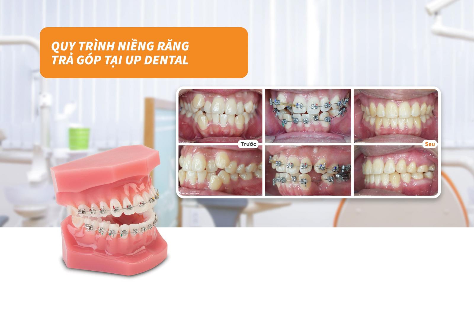 Quy trình niềng răng trả góp tại Up Dental 