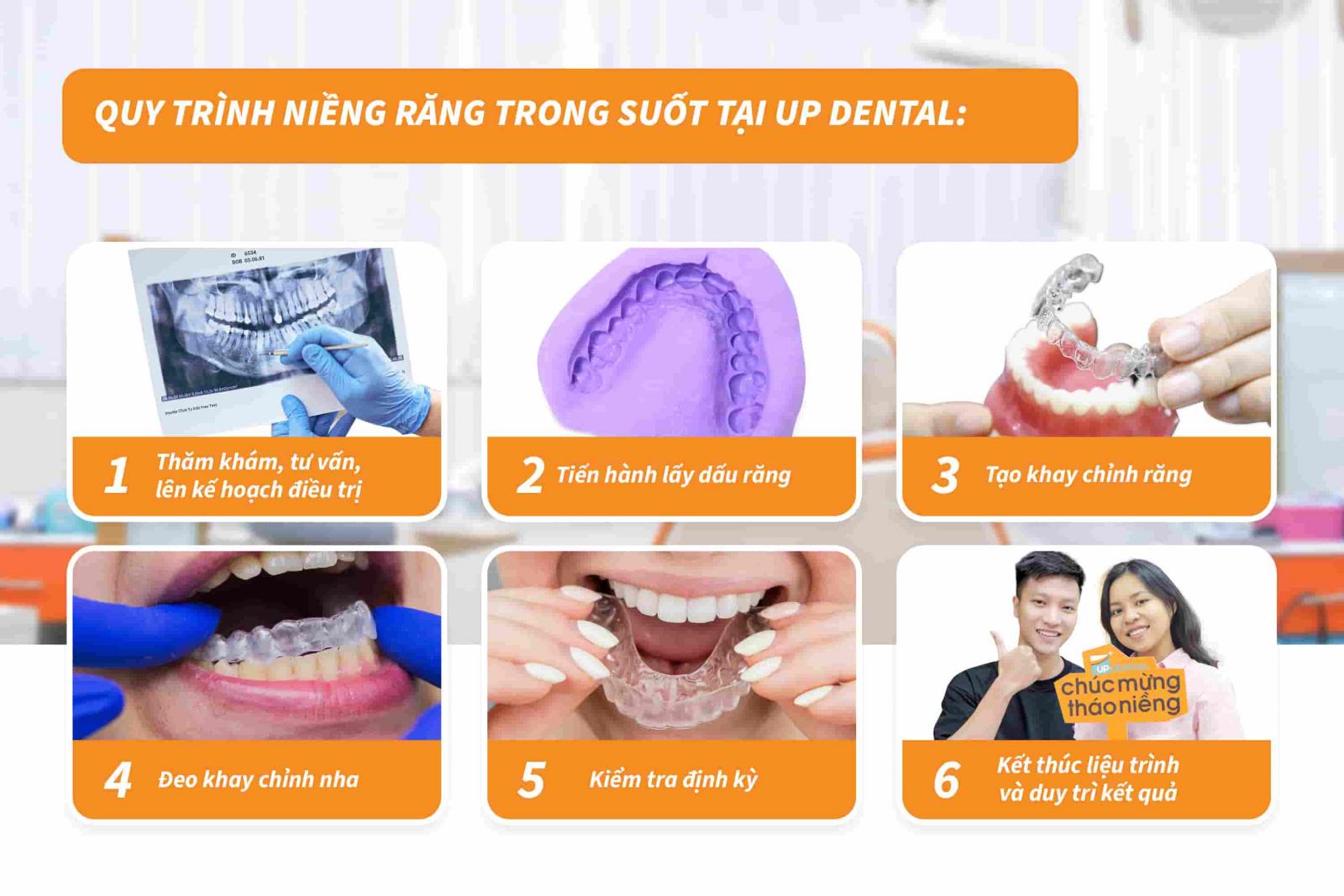 Quy trình niềng răng trong suốt tại Up Dental