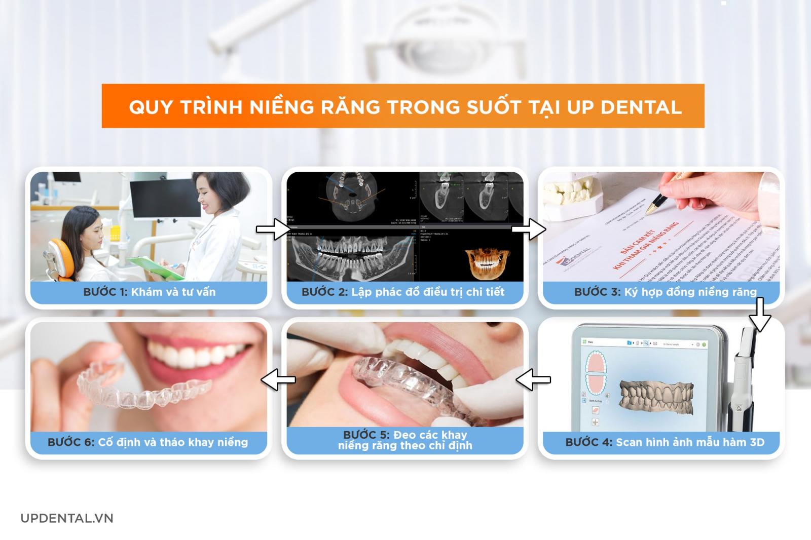 quy trình niềng răng trong suốt tại Up Dental