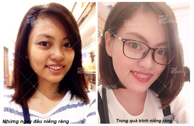 rang dep len sau khi nieng