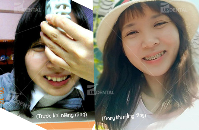 rang truoc va trong khi nieng