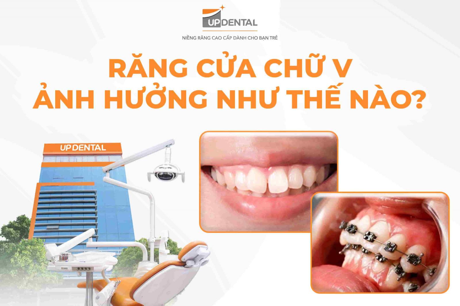Răng cửa chữ V ảnh hưởng như thế nào?