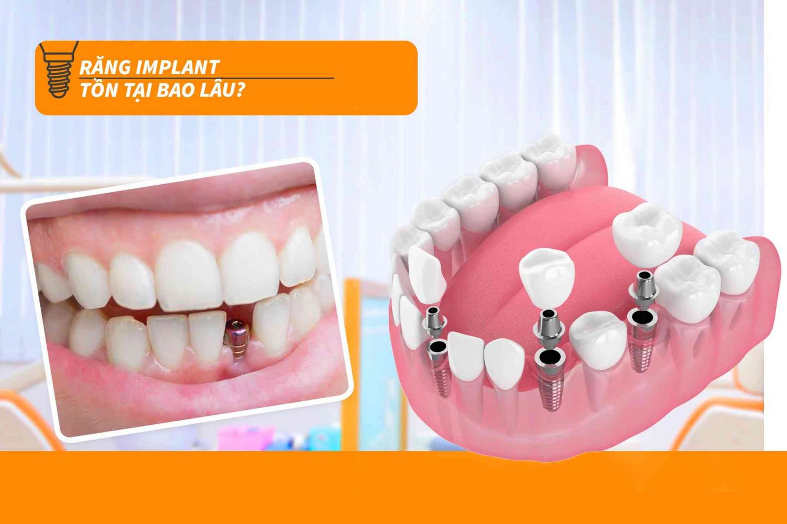 Răng Implant tồn tại bao lâu?