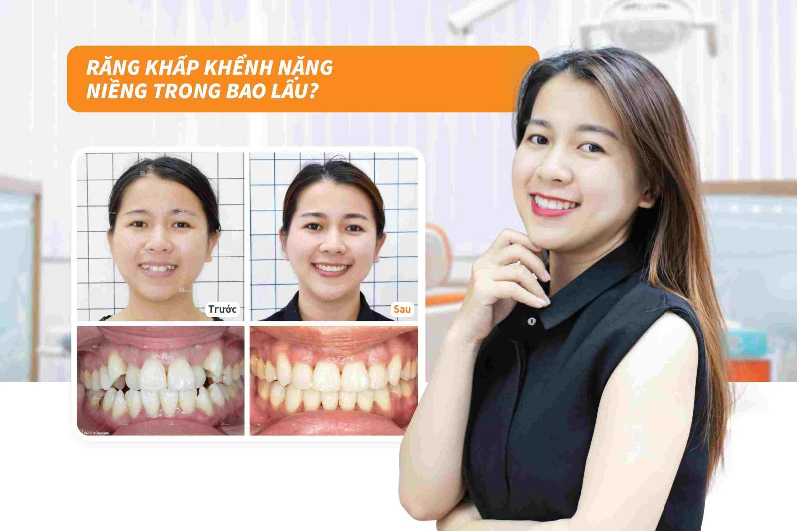 Niềng răng khấp khểnh nặng trong bao lâu?