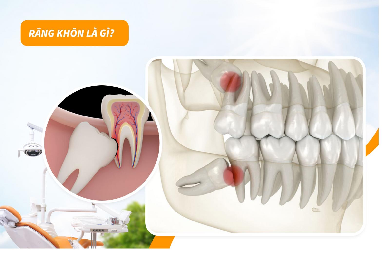 Răng khôn là gì?