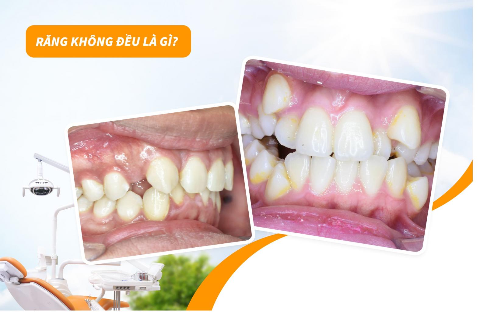 Răng không đều là gì?