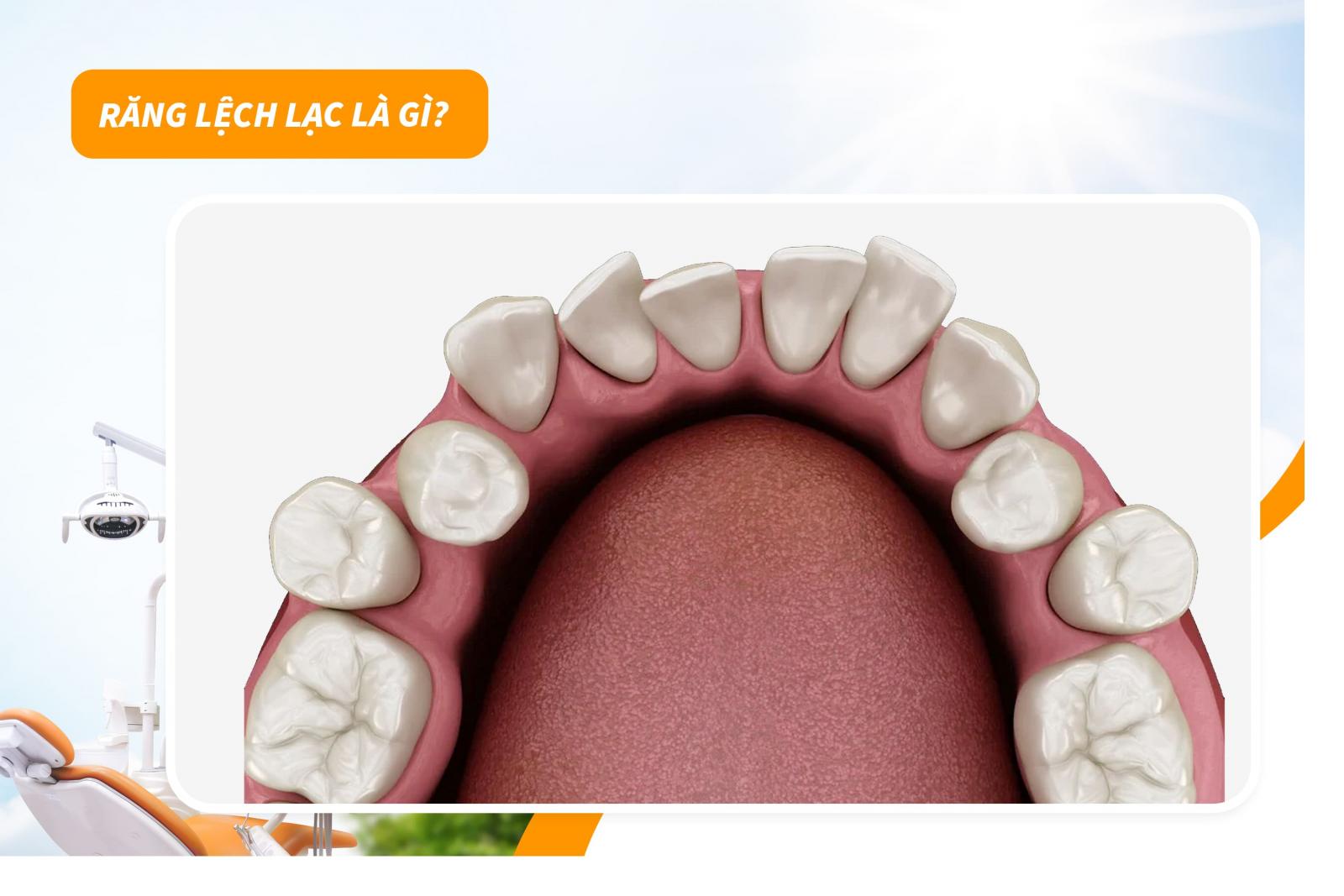 Răng lệch lạc là gì?