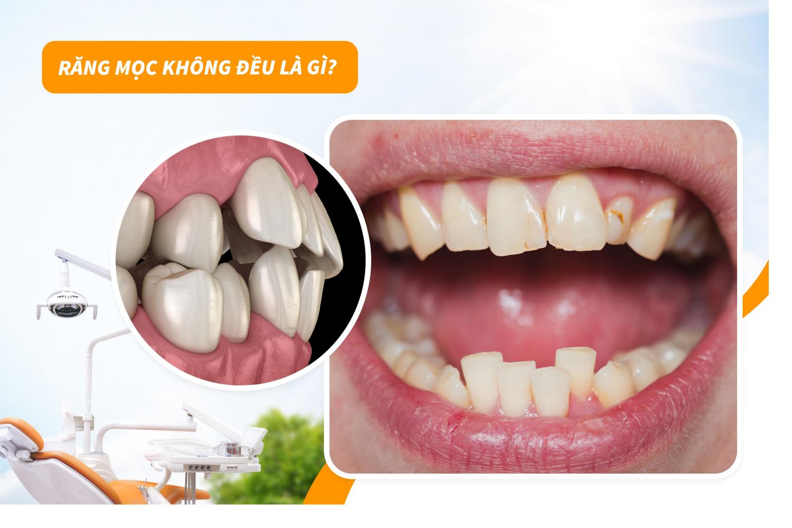 rang-moc-khong-deu-la-gi