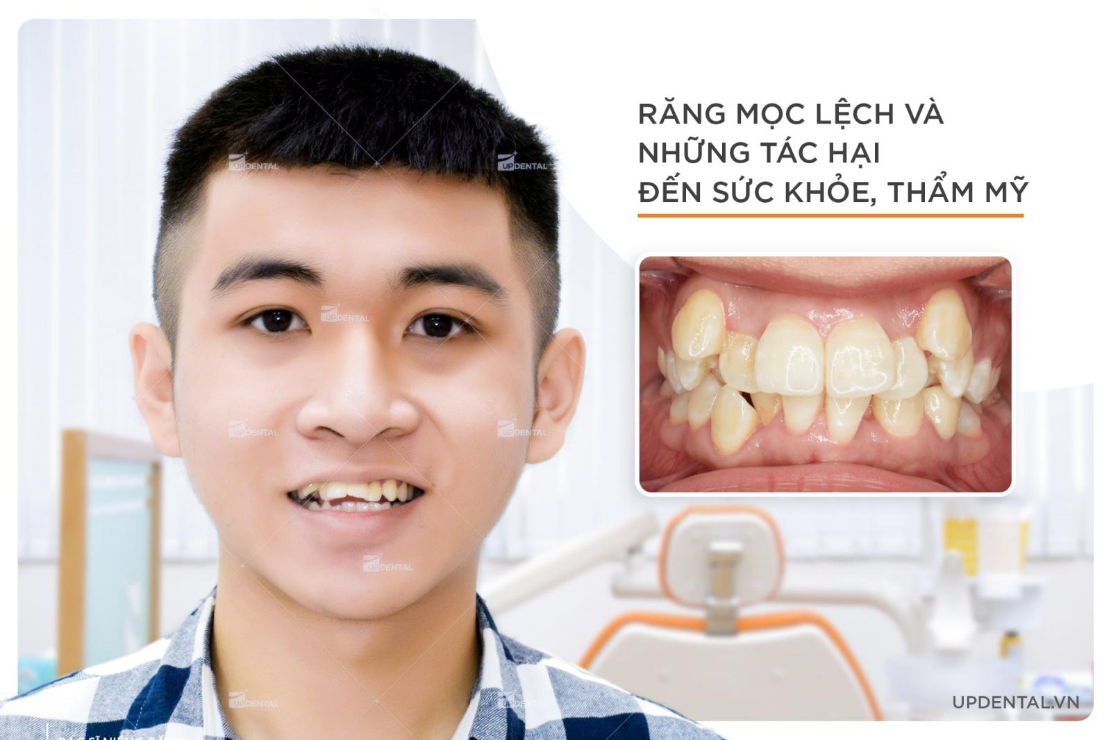 răng mọc lệch ảnh hưởng đến sức khỏe