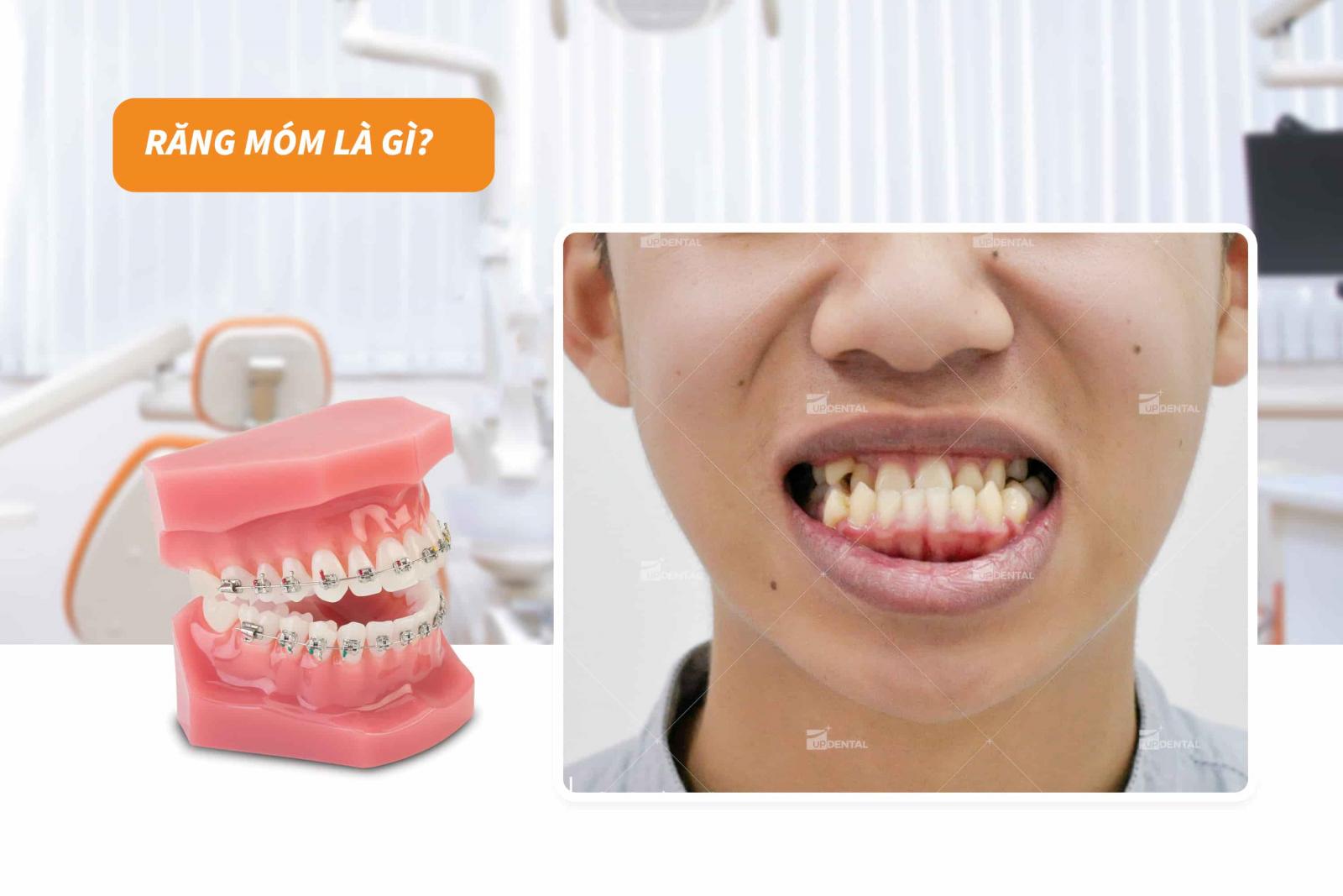 Răng móm là gì?