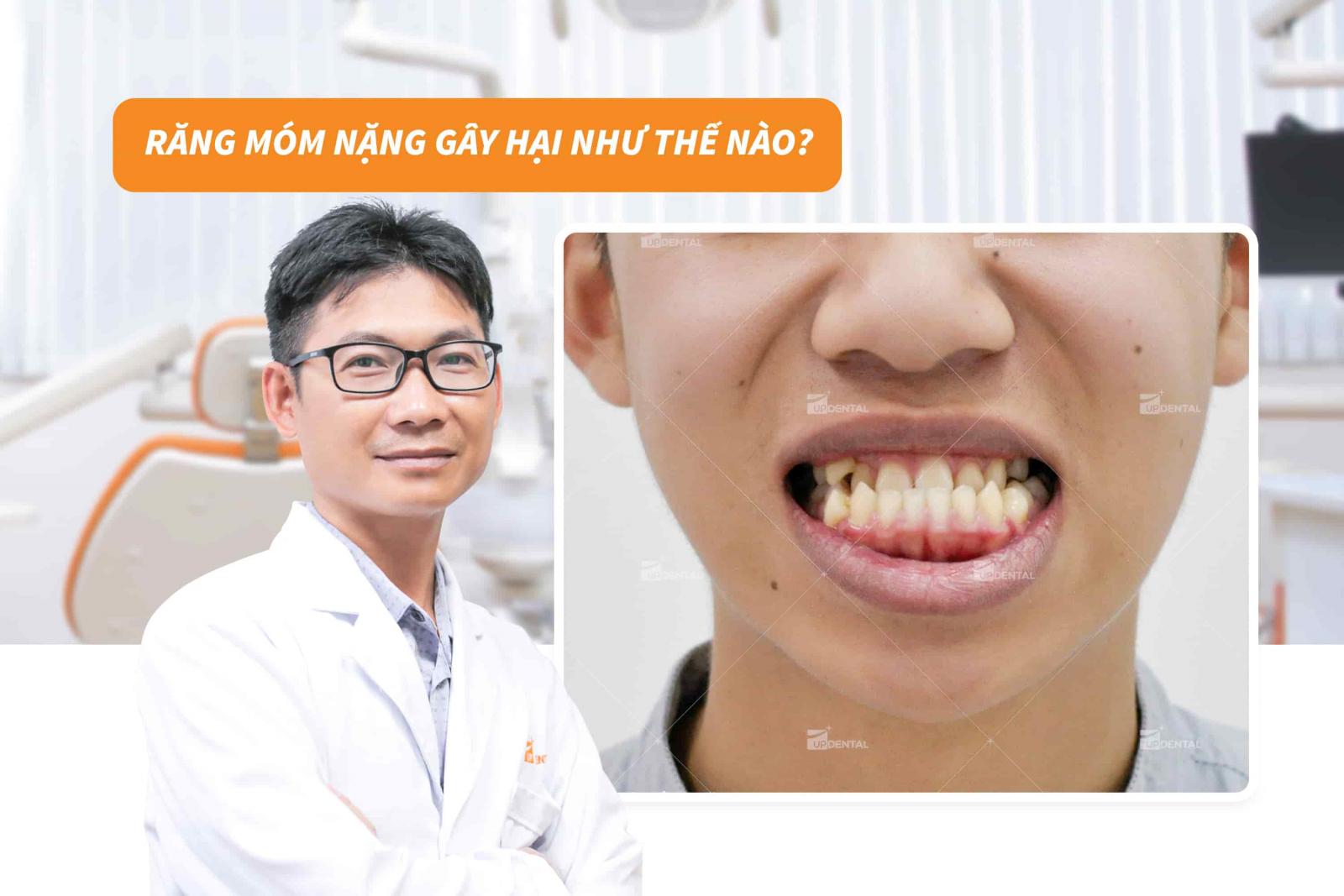 Răng móm nặng gây hại như thế nào?