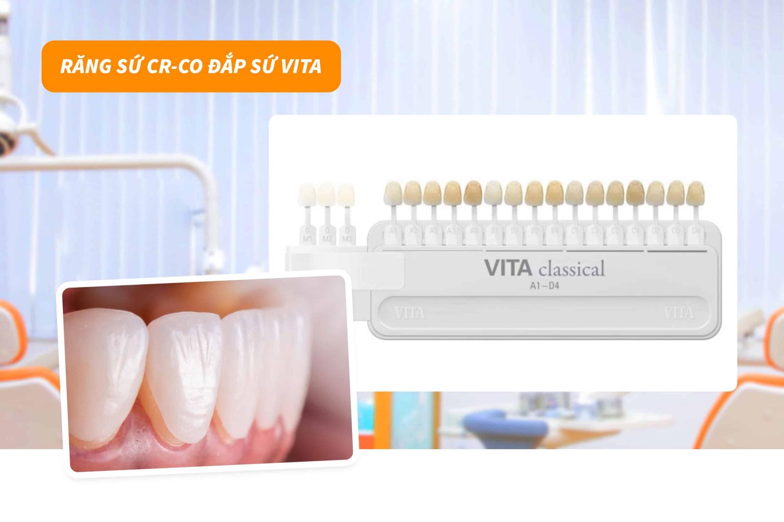 Răng sứ Cr-Co đắp sứ Vita 