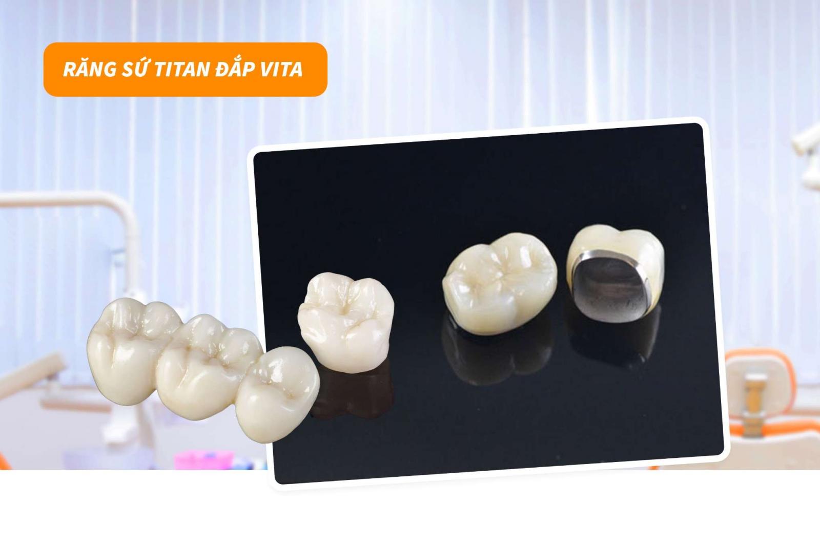 Răng sứ Titan đắp Vita