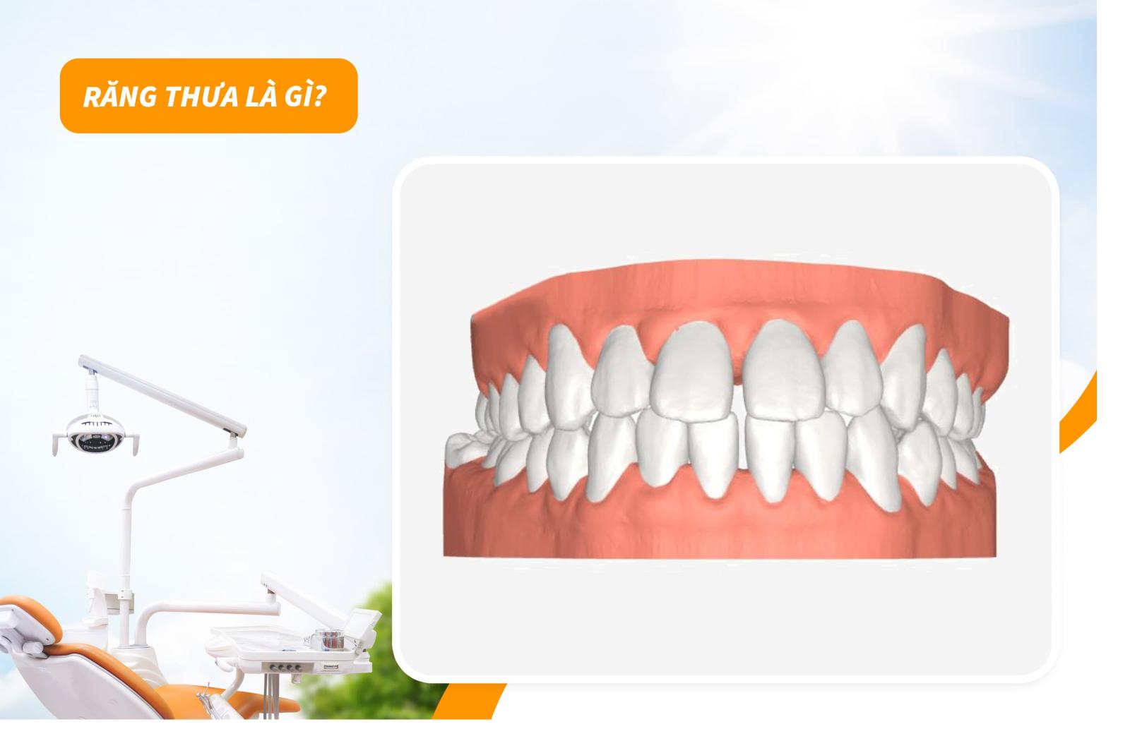 Răng thưa là gì?