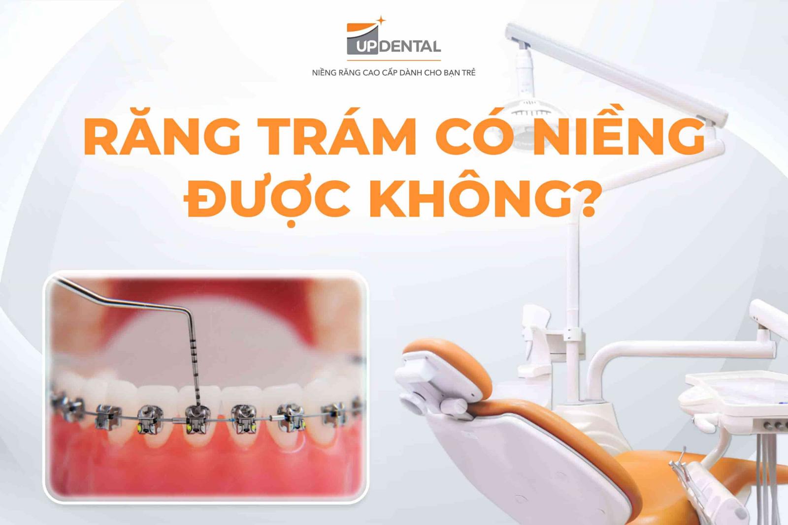 Răng trám có niềng được không?