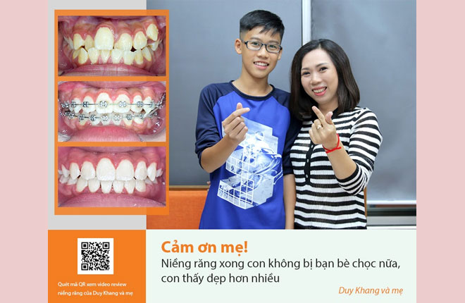 review niềng răng trẻ em Duy Khang