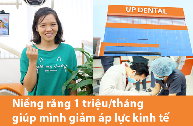Review niềng răng thưa chìa