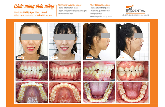 Trước và sau khi niềng răng