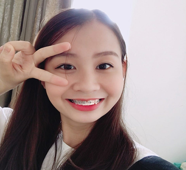Hinh anh sau khi nieng rang ho
