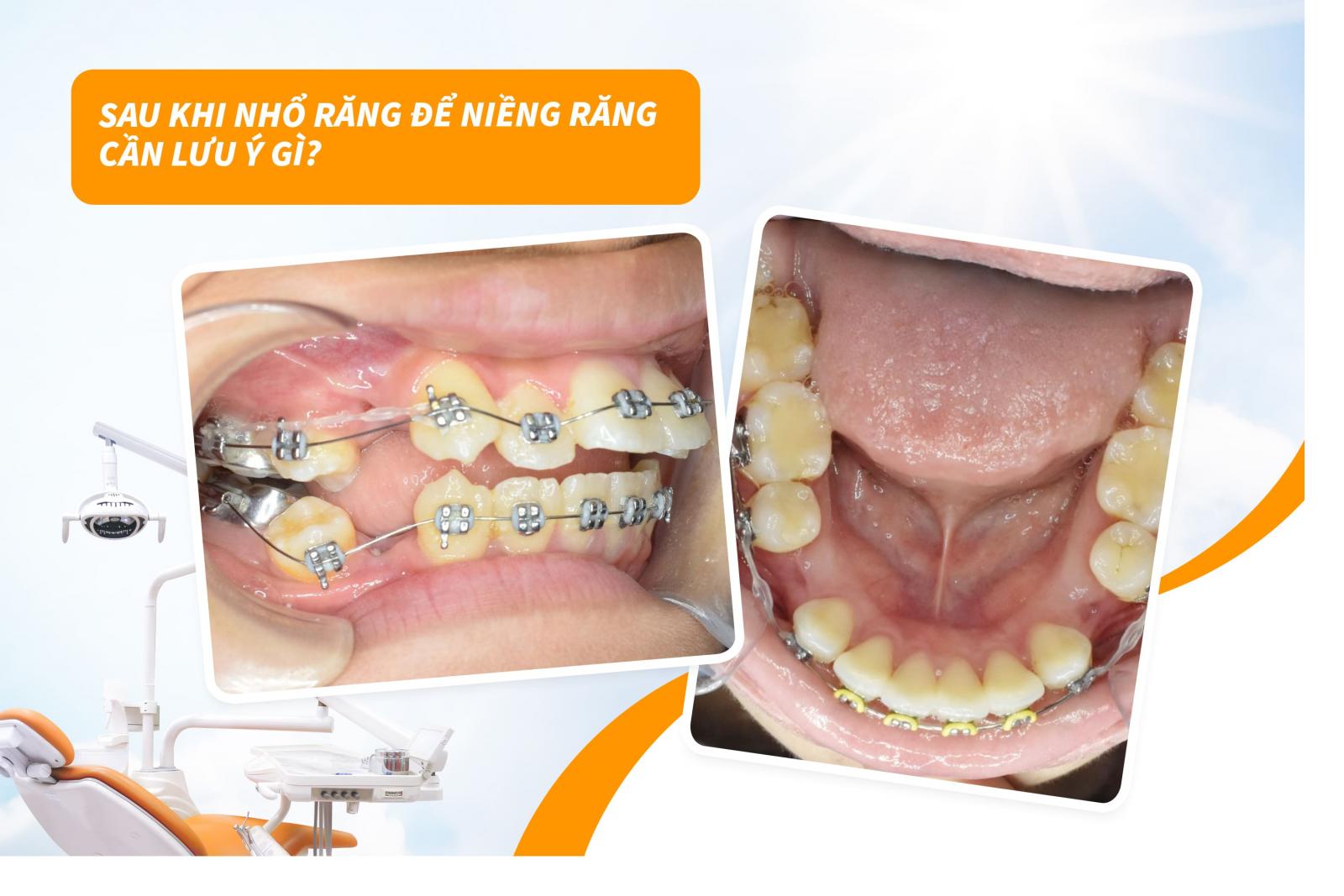 Trước khi nhổ răng để niềng răng cần lưu ý gì?