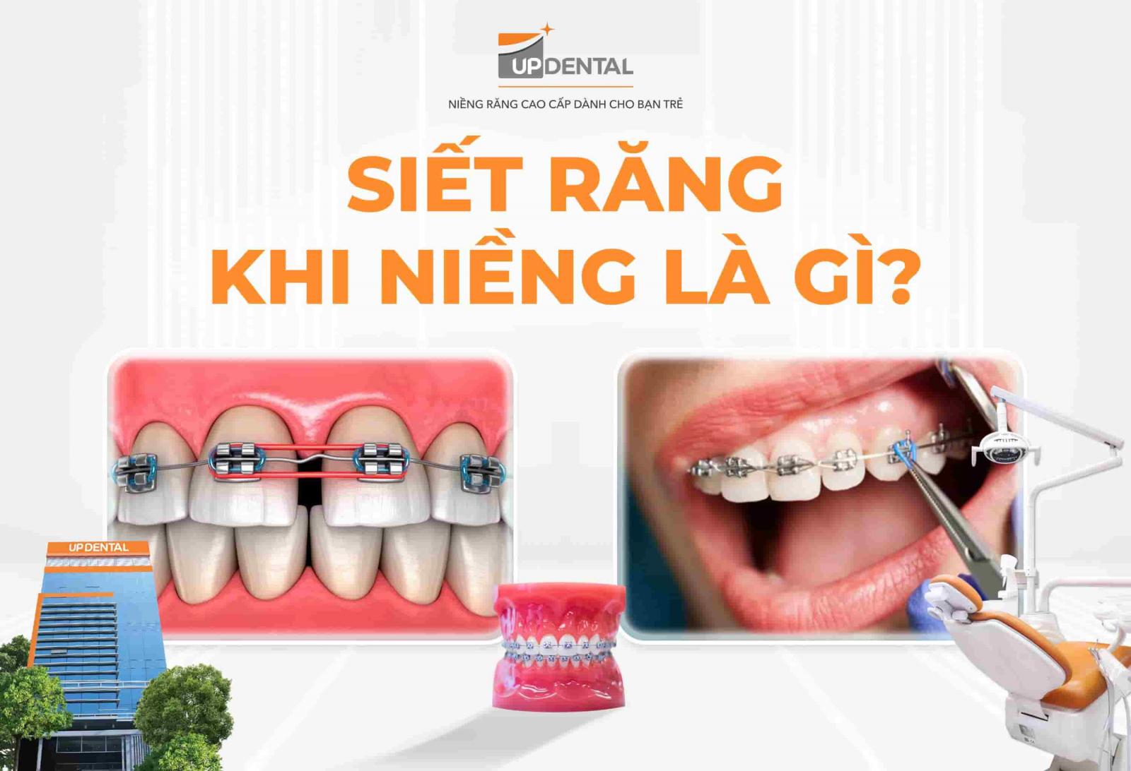 Siết răng khi niềng là gì?