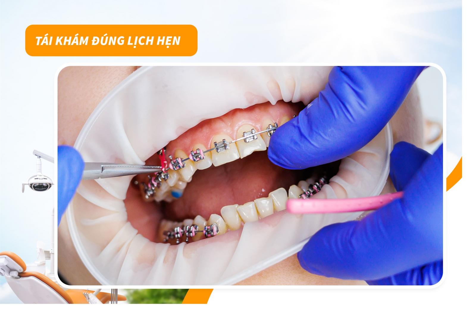 Lưu ý khi niềng răng 6: Tái khám đúng hẹn