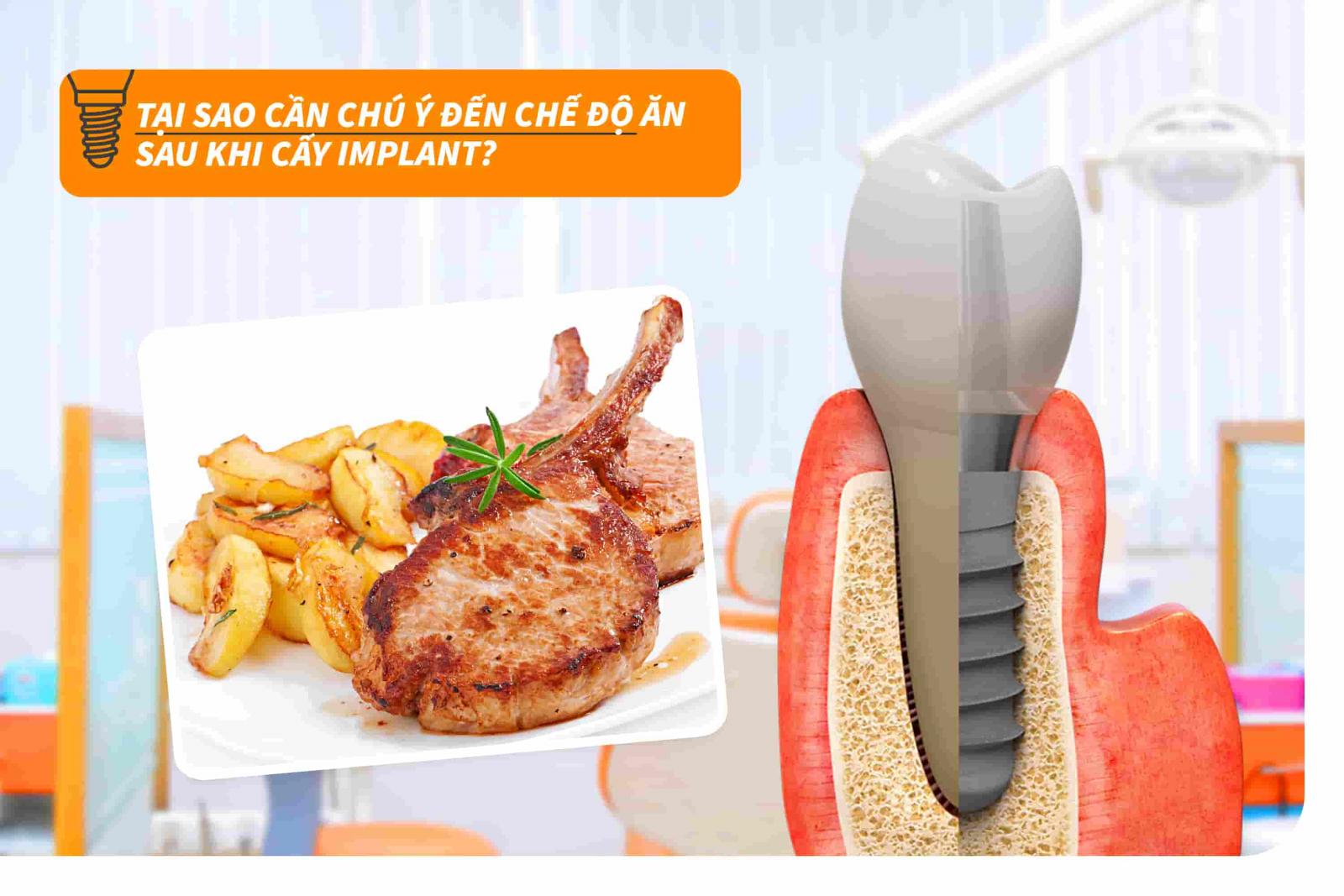 Tại sao cần chú ý đến chế độ ăn sau khi cấy Implant?
