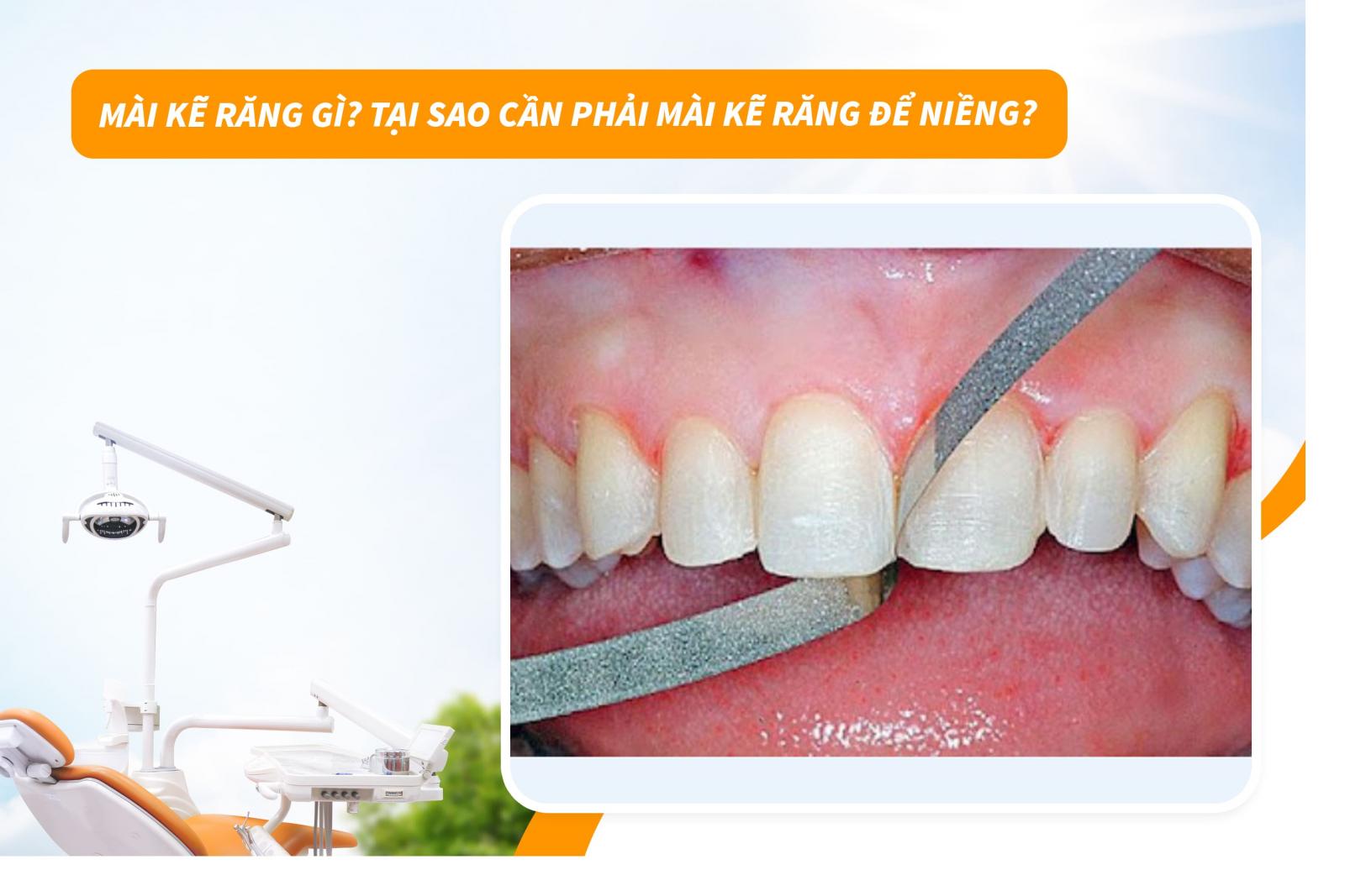 Mài kẽ răng gì? Tại sao cần phải mài kẽ răng để niềng?