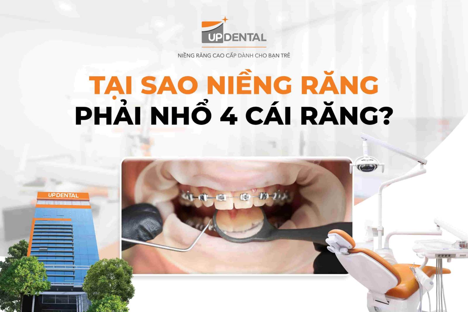Tại sao niềng răng phải nhổ 4 cái răng?