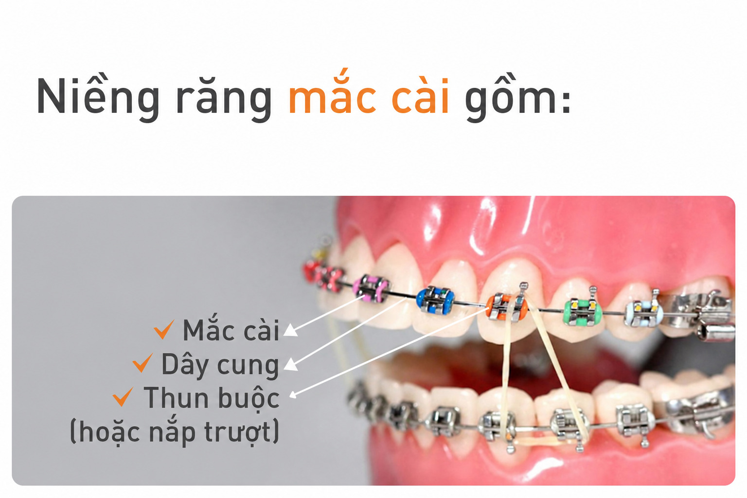 Thành phần của niềng răng mắc cài kim loại