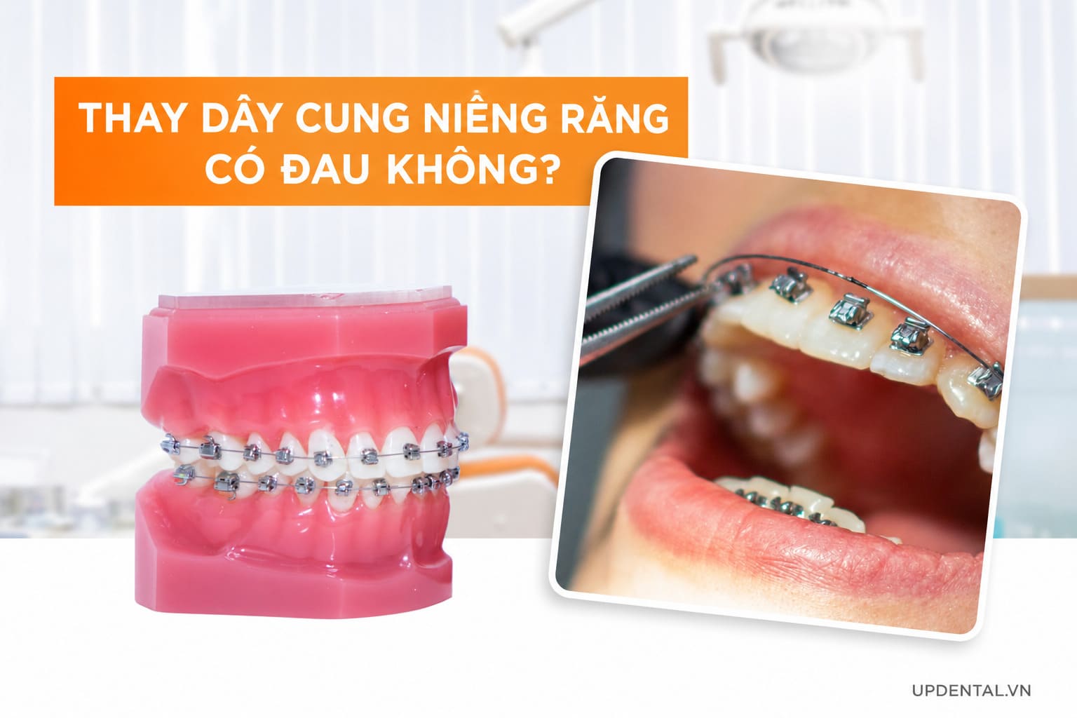 Thay dây cung niềng răng có đau không?