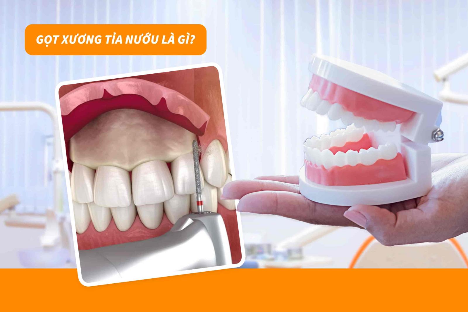 Gọt xương tỉa nướu là gì?