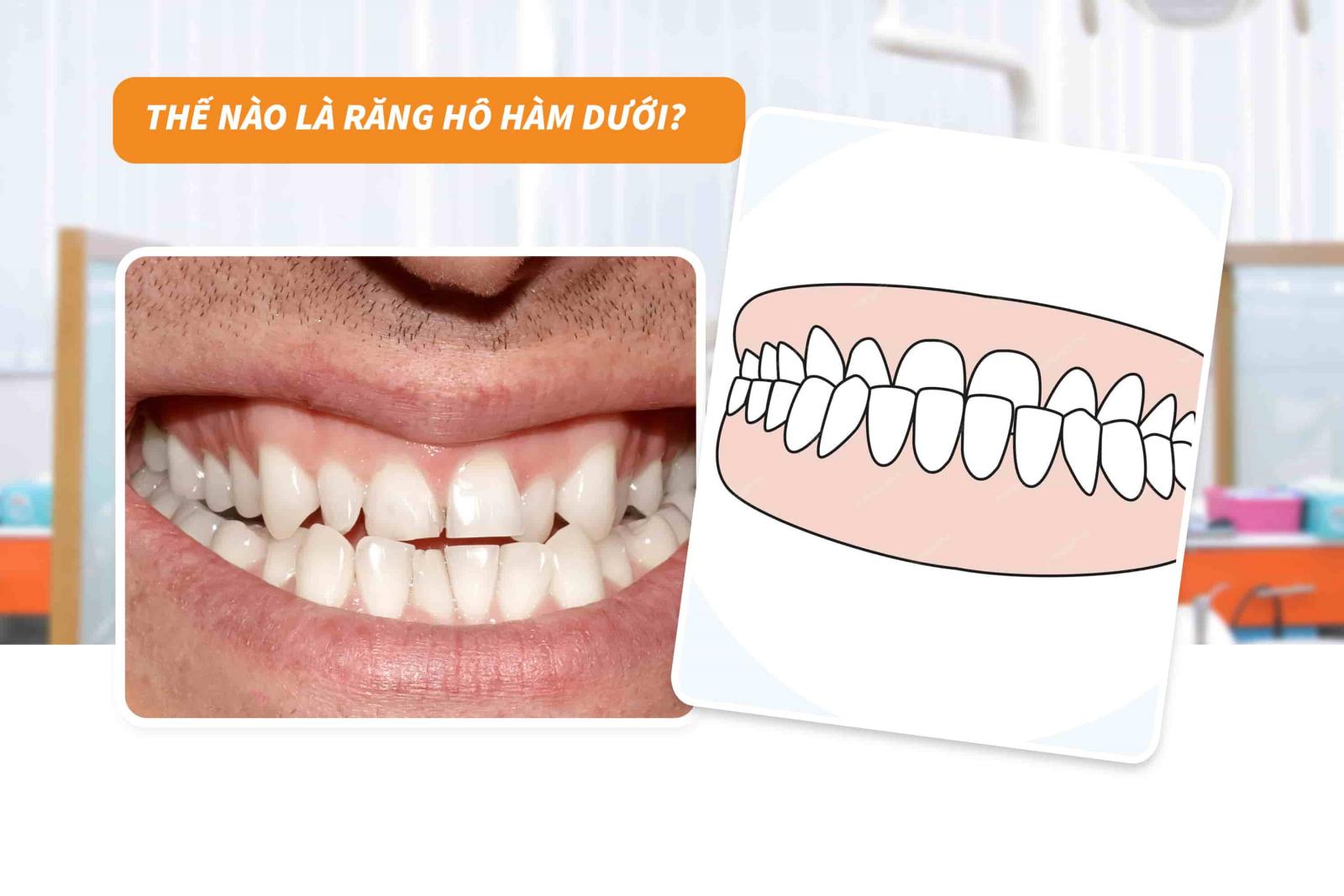 Thế nào là răng hô hàm dưới?