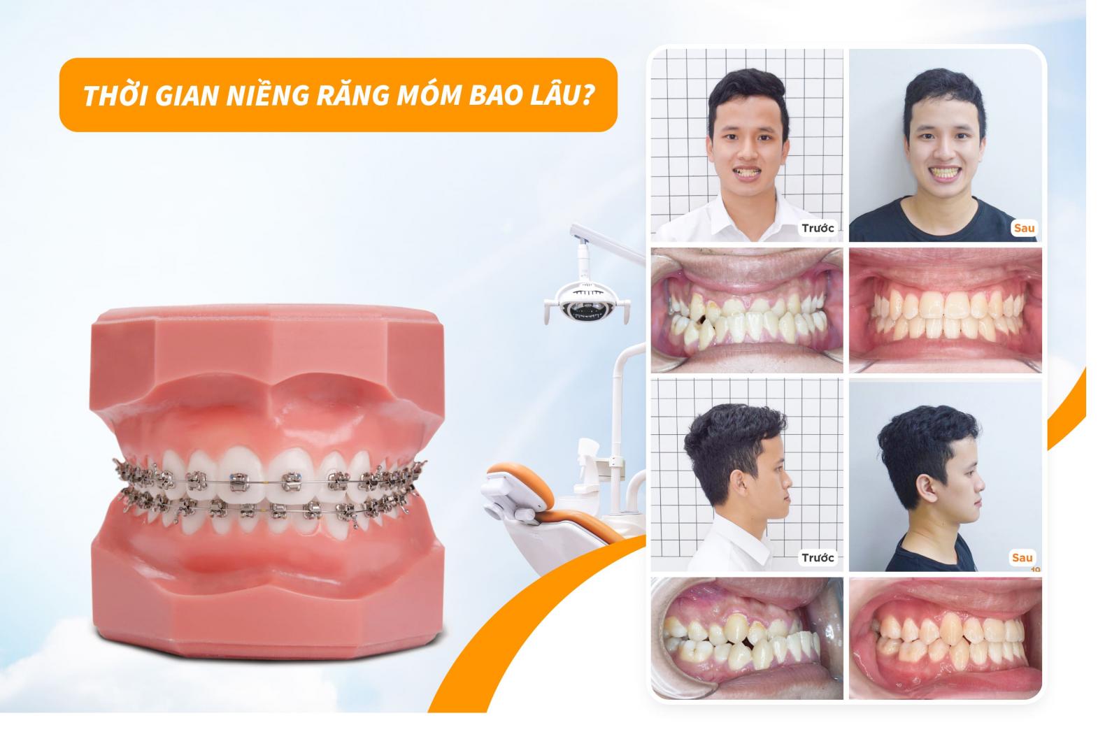 Thời gian niềng răng móm bao lâu?