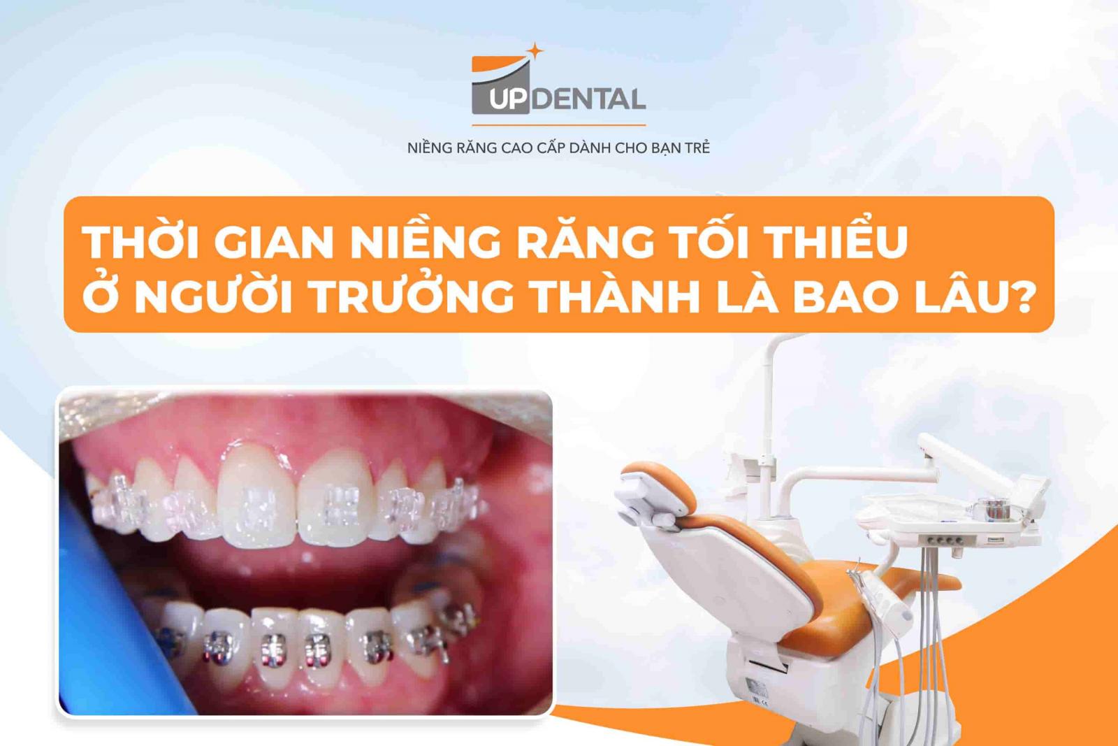 Thời gian niềng răng tối thiểu ở người trưởng thành là bao lâu?