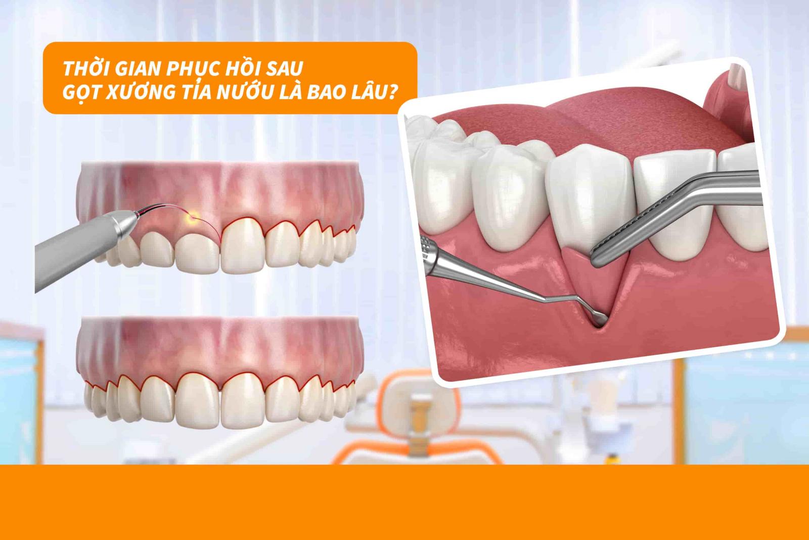 Thời gian phục hồi sau gọt xương tỉa nướu