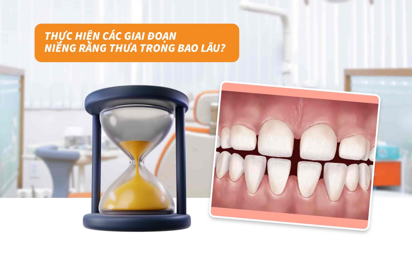 Thực hiện các giai đoạn niềng răng thưa trong bao lâu?