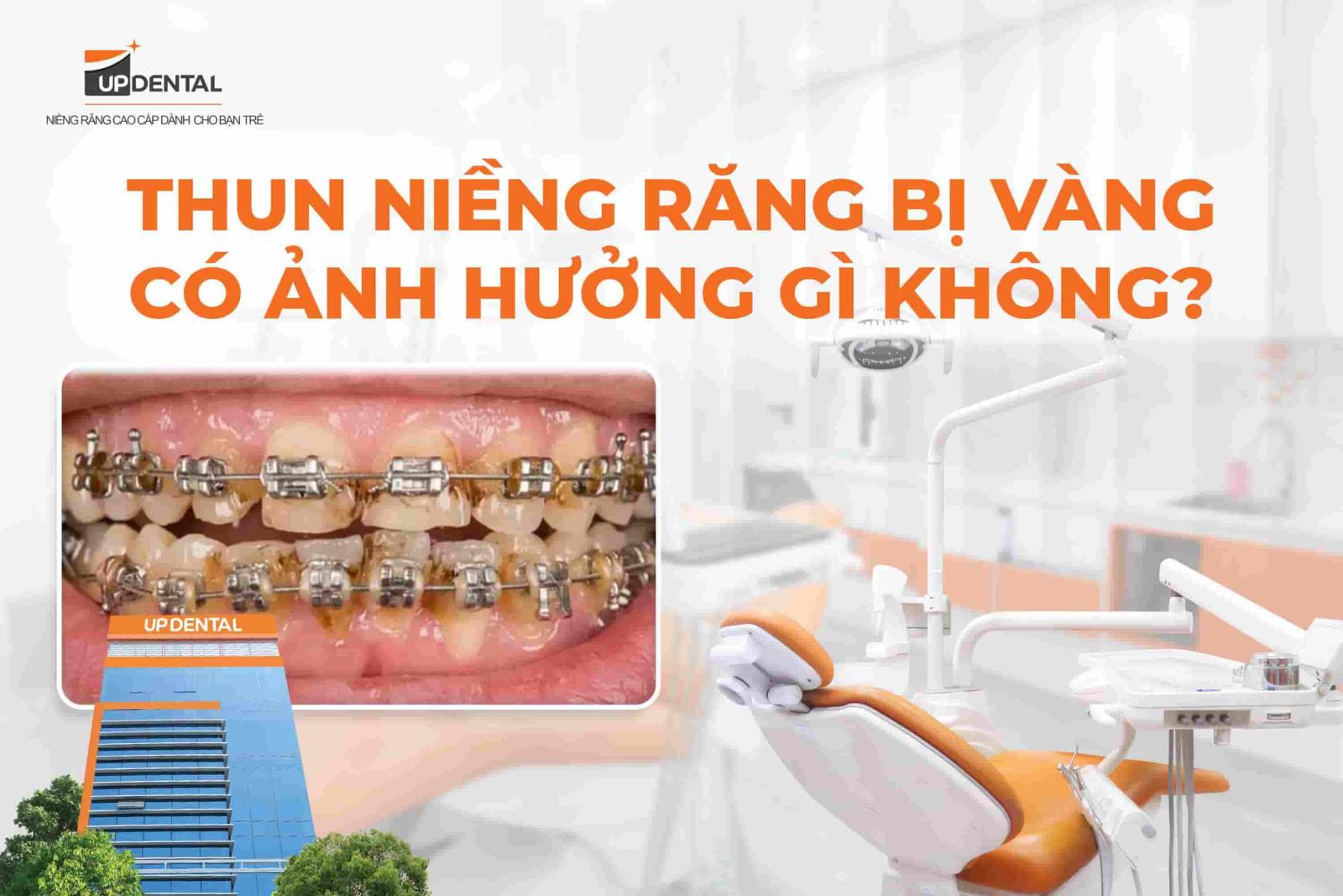 Thun niềng răng bị vàng có ảnh hưởng gì không?