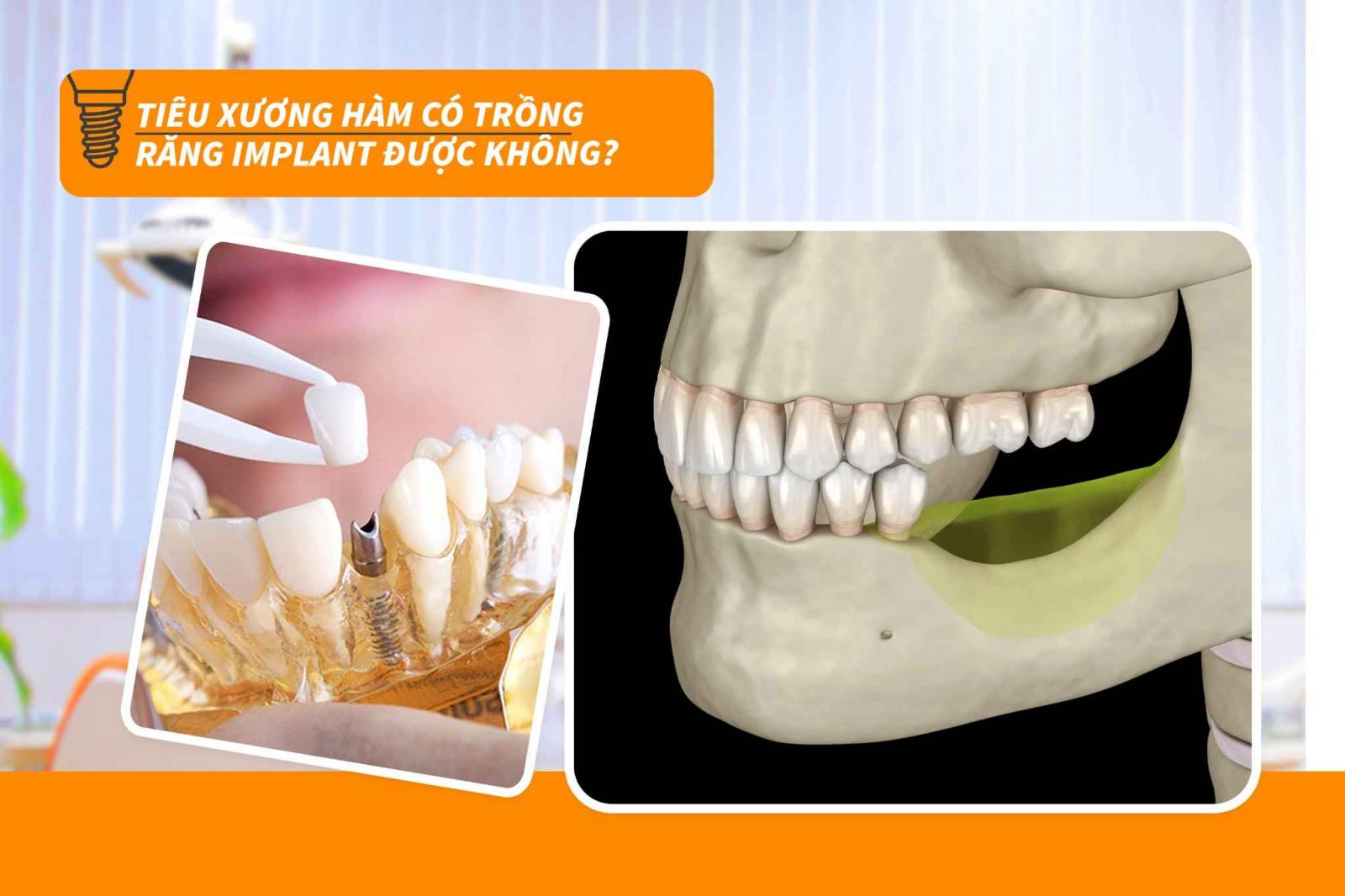 Tiêu xương hàm có trồng răng Implant được không?