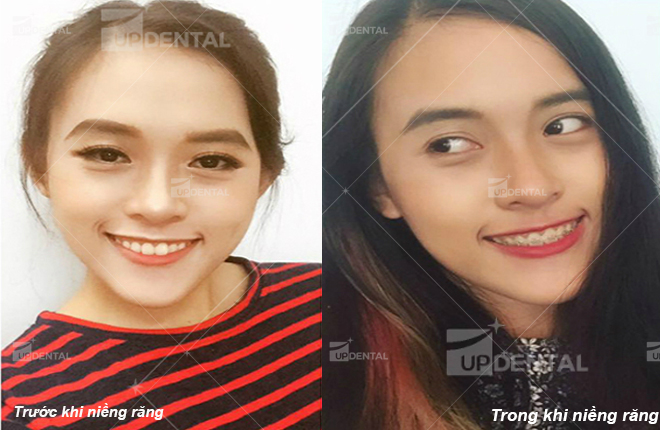 hinh anh rang mom truoc va trong khi nieng rang