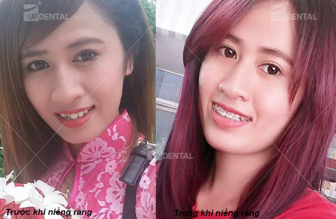 anh truoc va sau nieng rang